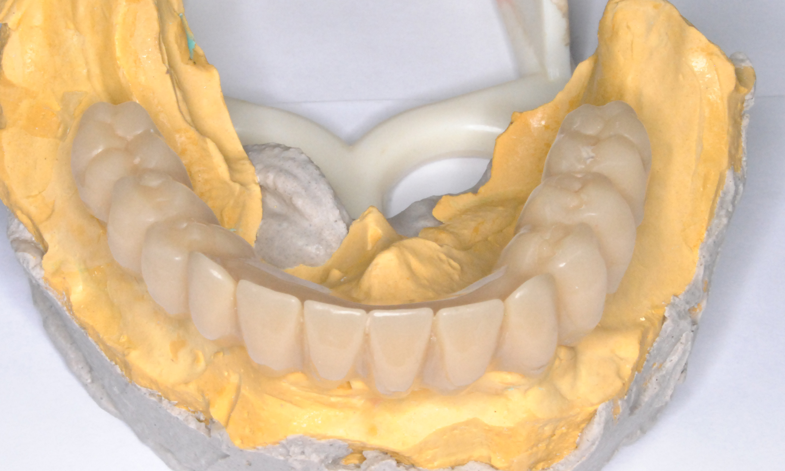 Caso clínico — Implantes