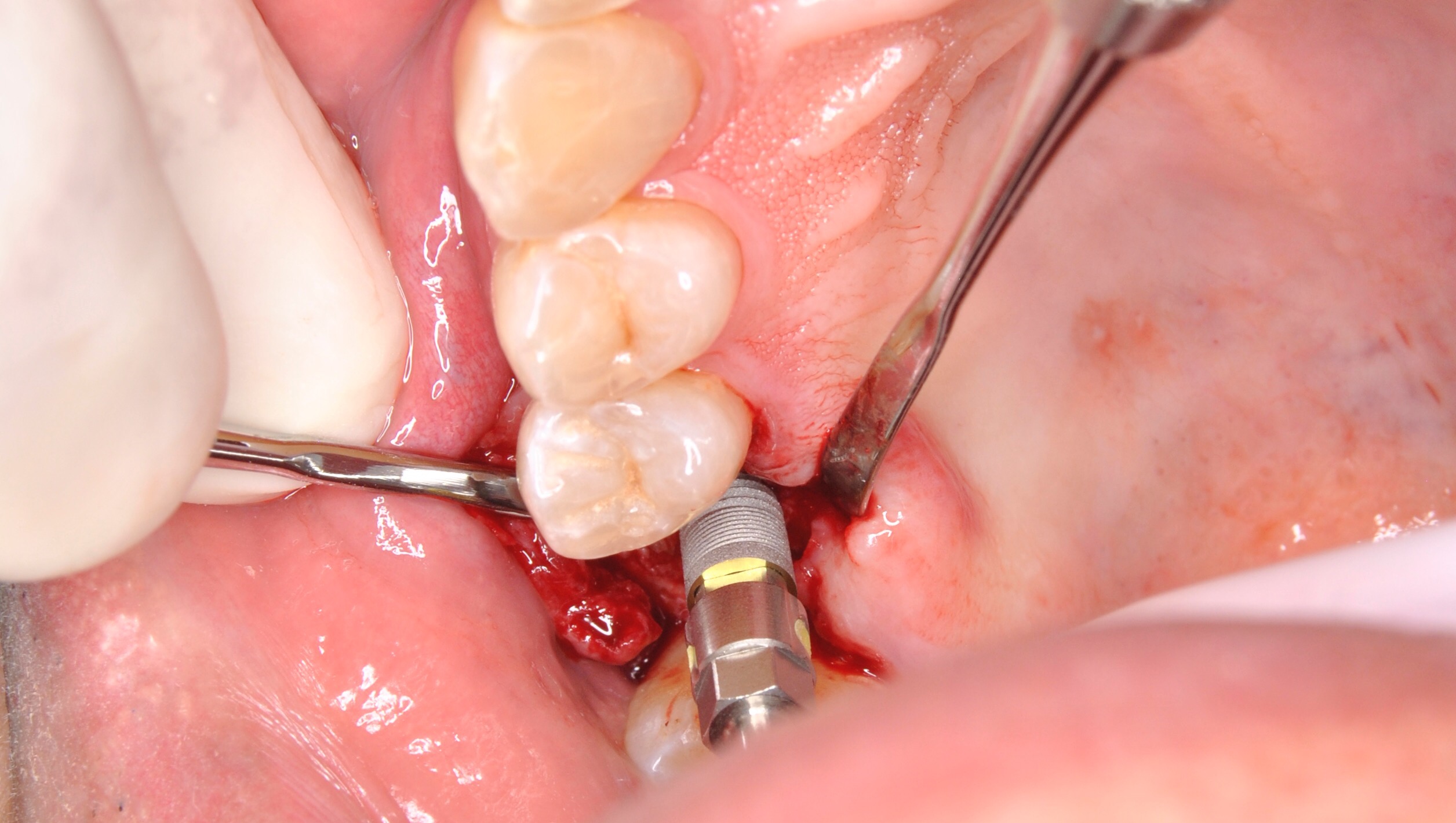Caso clínico — Implantes