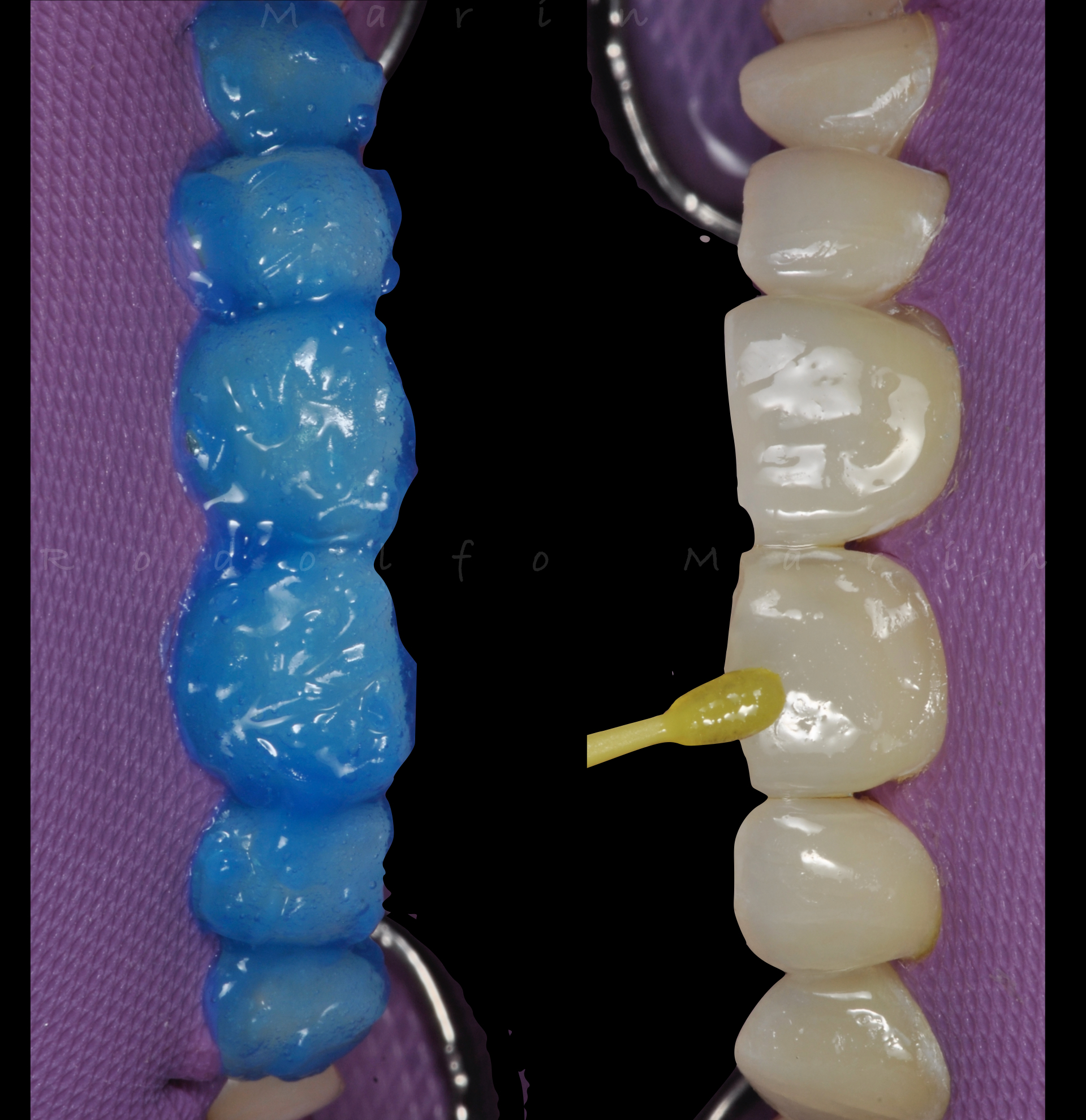 Caso clínico — Carillas