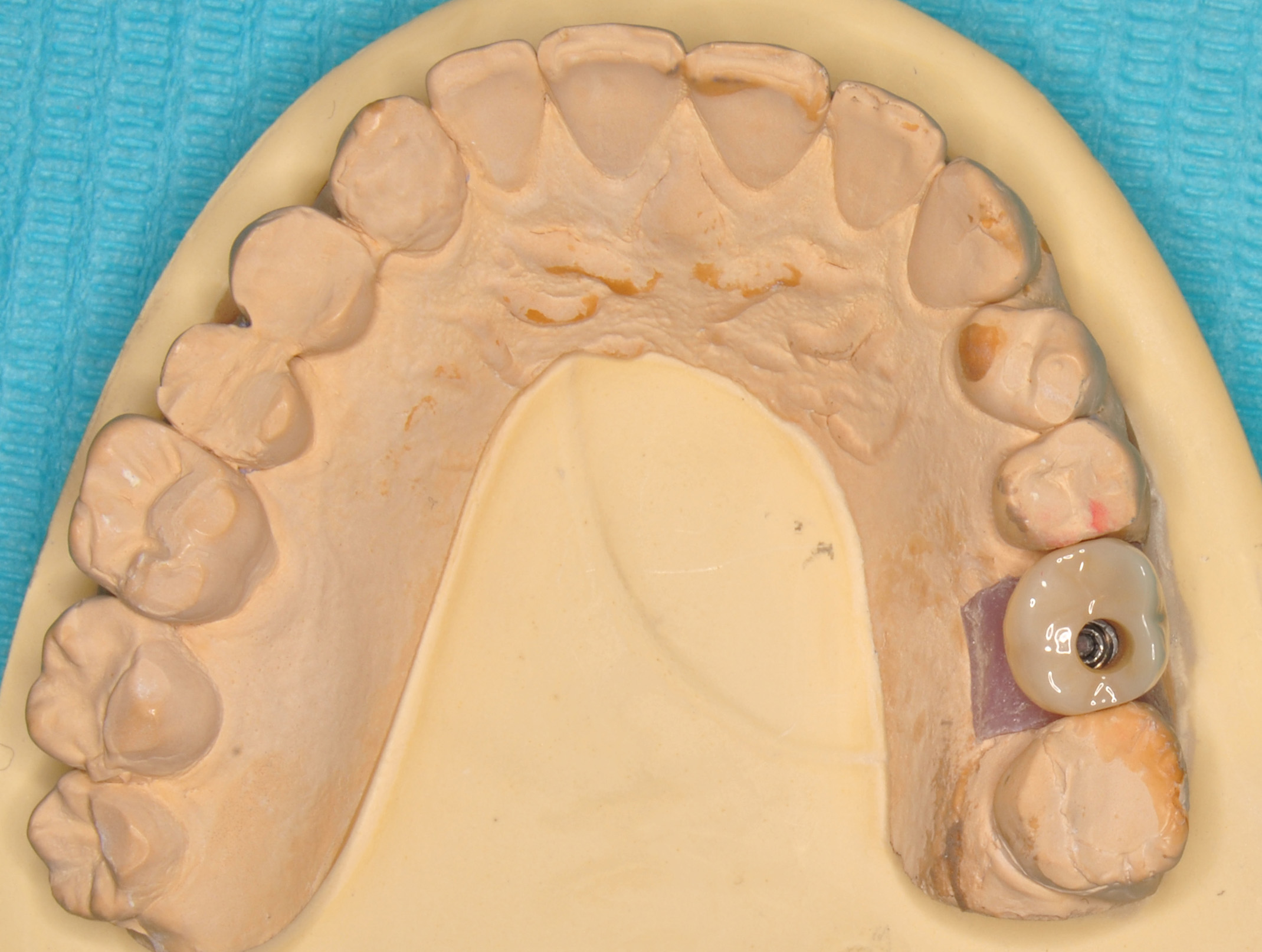 Caso clínico — Rehabilitación sobre implantes