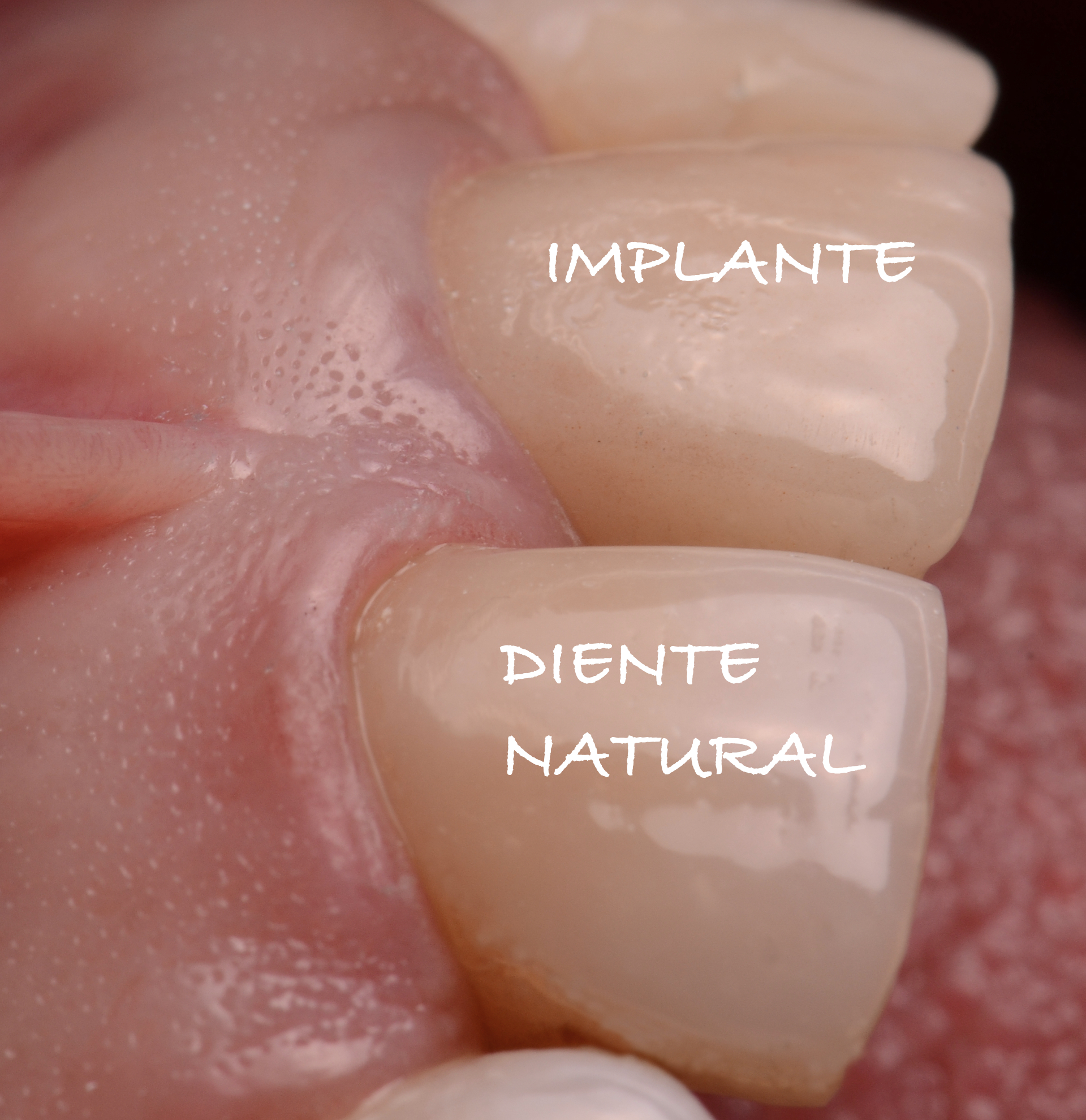 Caso clínico — Rehabilitación sobre implantes