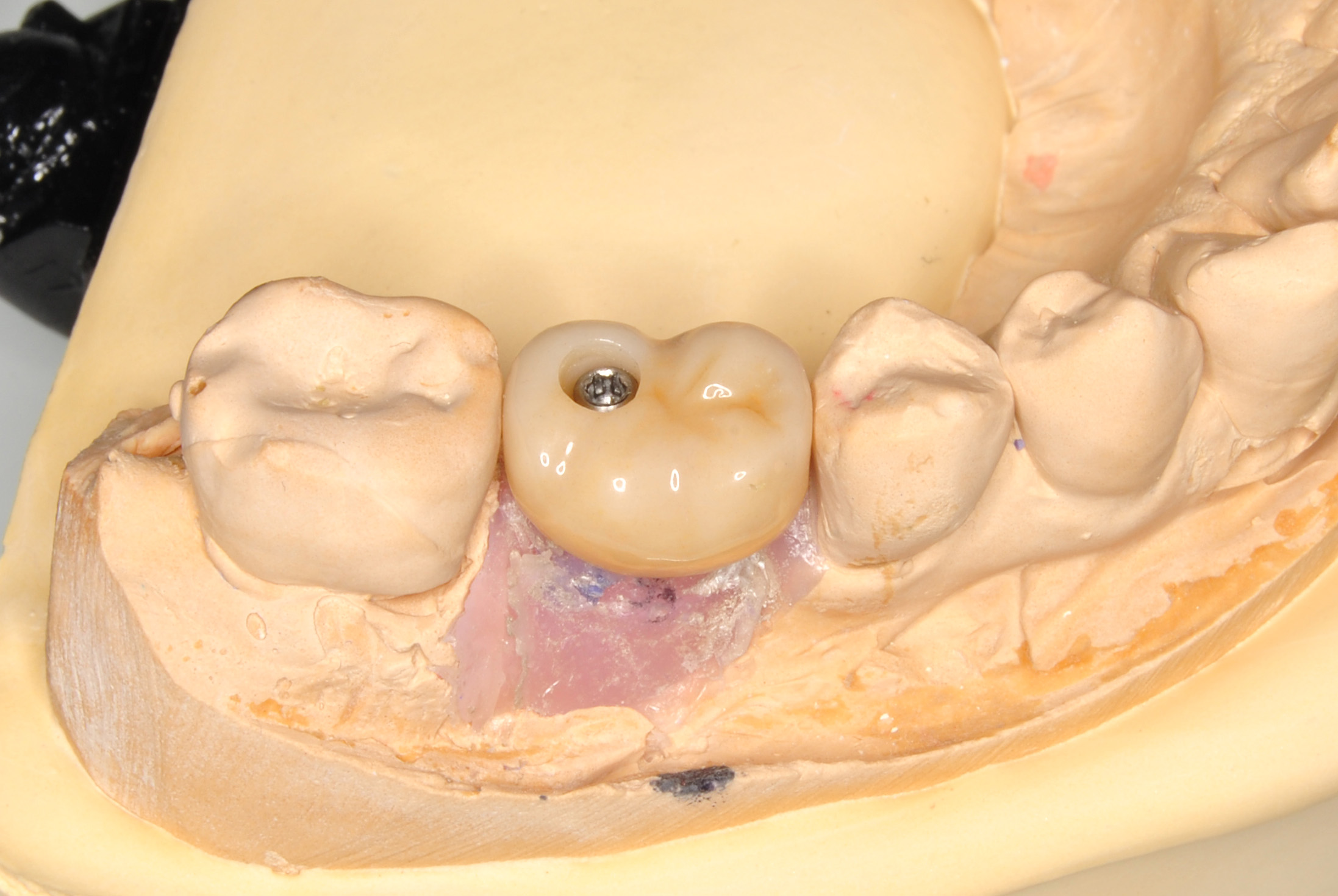 Caso clínico — Rehabilitación sobre implantes