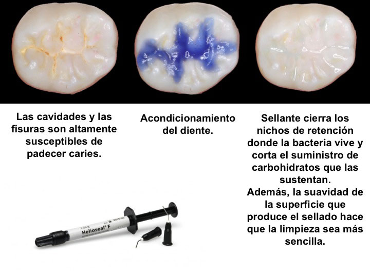 Caso clínico — Sellantes