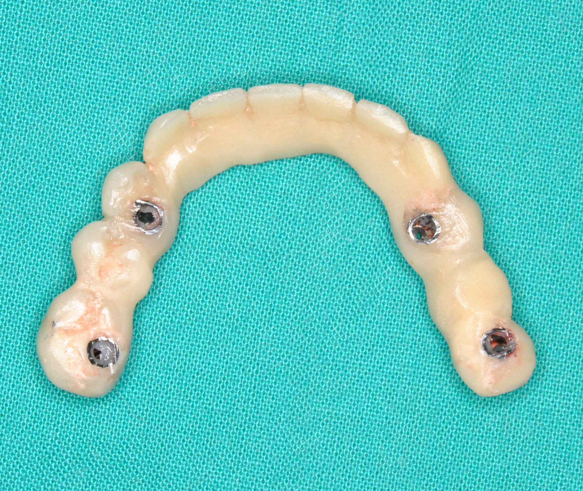 Caso clínico — Implantes