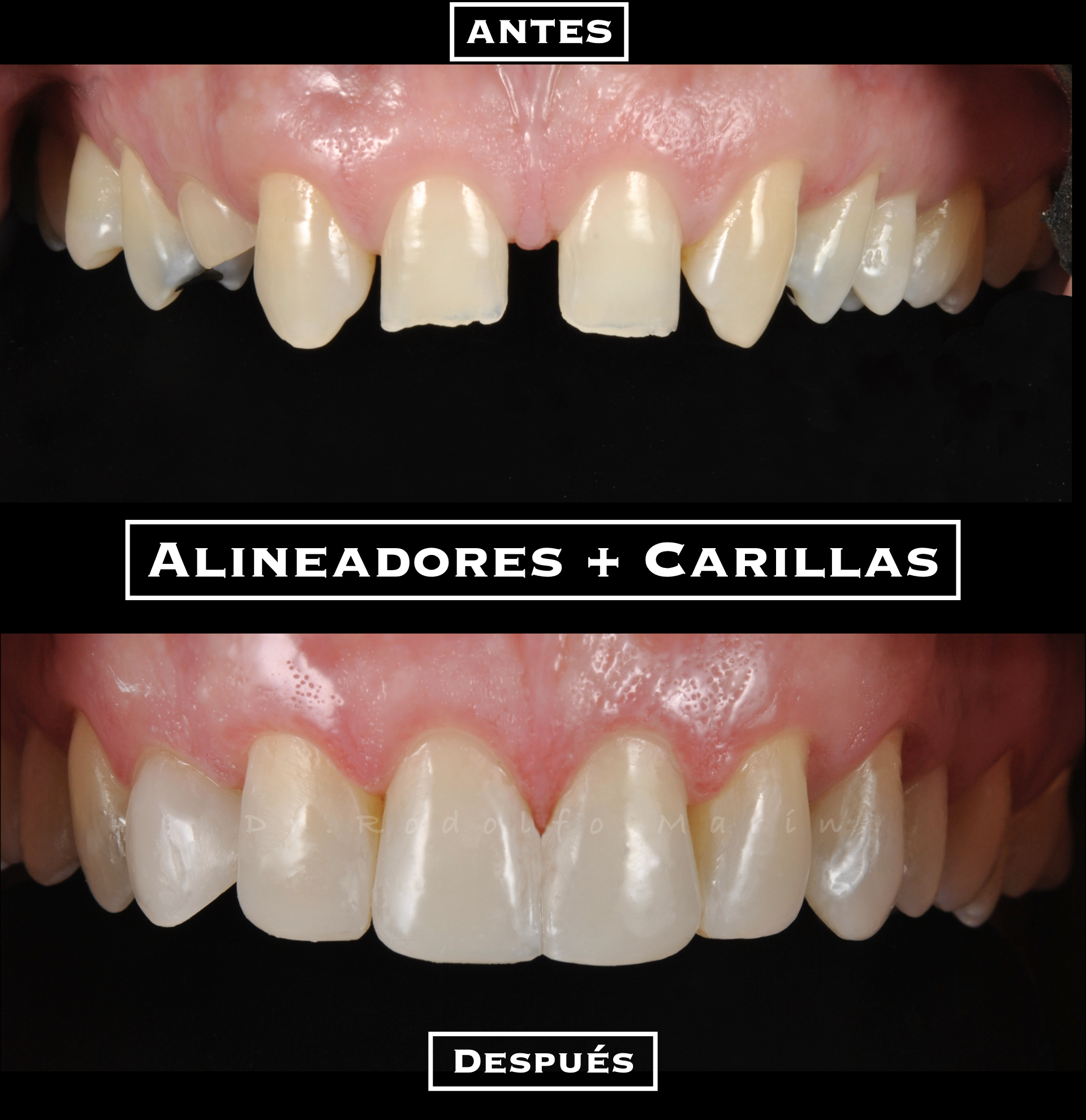 Caso clínico — Carillas