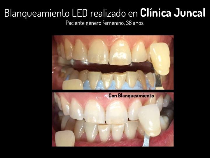 Caso clínico — Blanqueamiento LED